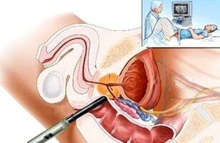 moyens de diagnostiquer la prostatite
