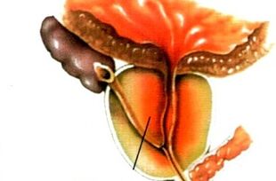 qu'est-ce que la prostatite chez les hommes