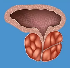 Caractéristiques de la prostatite
