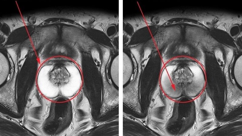 une prostate saine et enflammée avec prostatite chronique