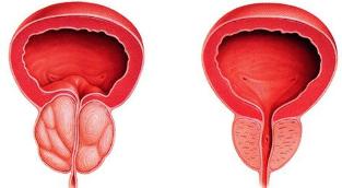 la différence de malade et une prostate saine