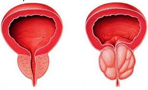 la prostate