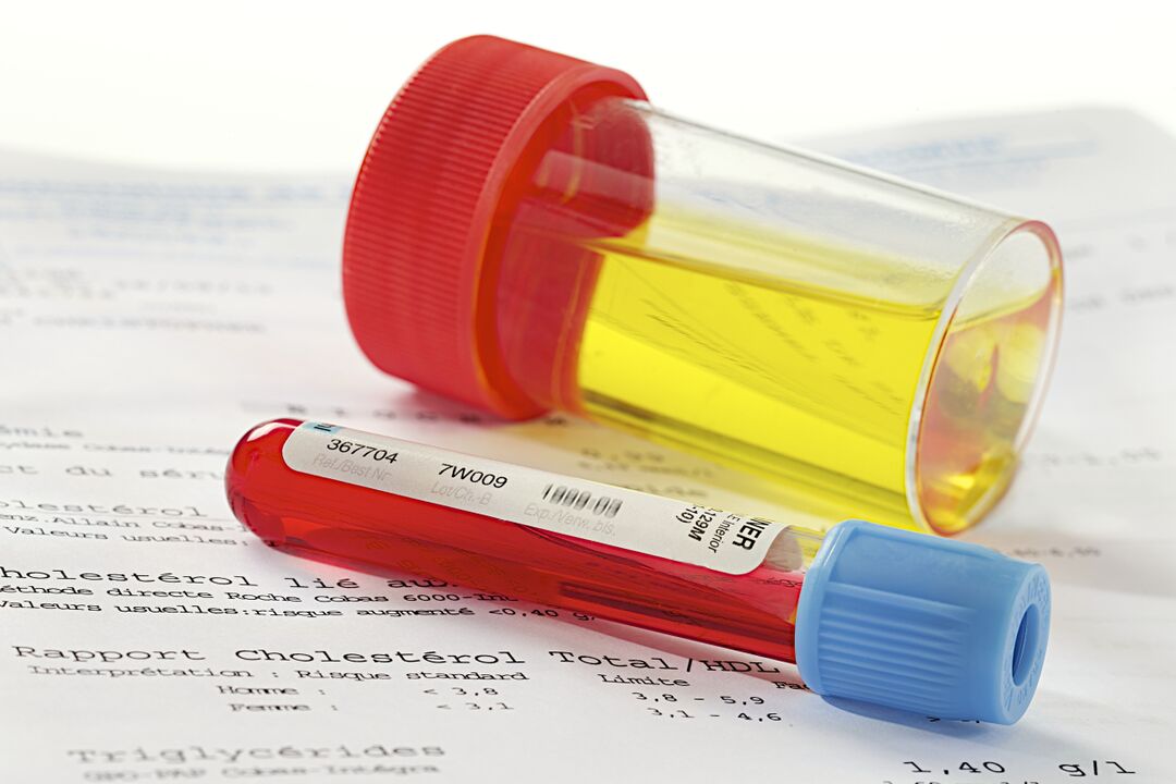 Une analyse de sang et d'urine aidera à déterminer la présence d'une prostatite.