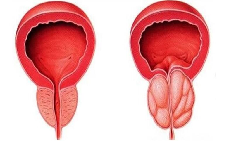 prostate saine et enflammée avec prostatite